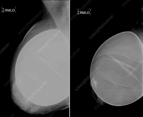 mammography and implants